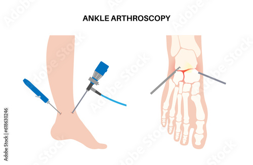 Ankle arthroscopy poster