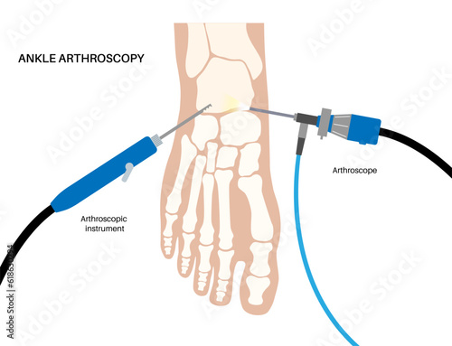 Ankle arthroscopy poster