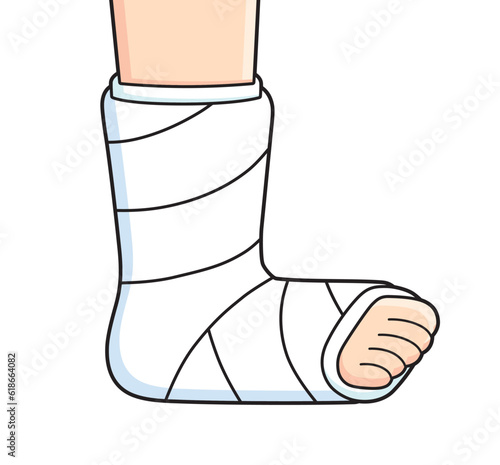 Broken leg with orthopedic cast isolated vector illustration