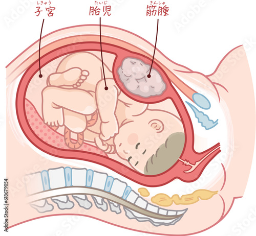 筋腫合併妊娠のイラスト、子宮筋腫、妊娠、子宮筋腫のある女性、胎児、赤ちゃん