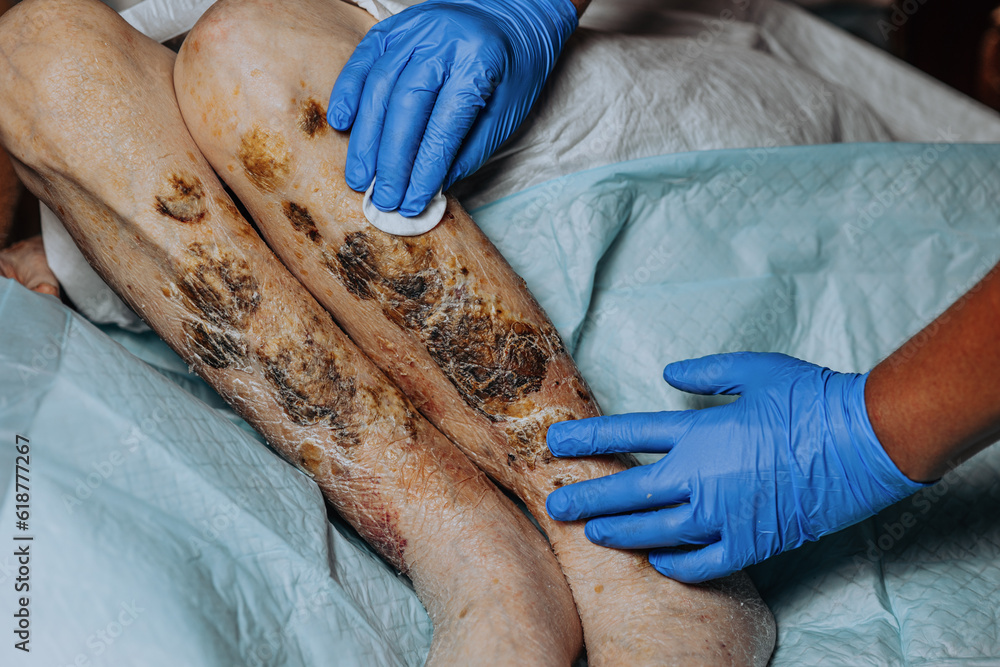 Skin lesions on the leg. Symptoms characteristic of the elderly begin with a red rash in a small circle and spread to a wider area. Large scabs on the legs. Elderly care. Consequences of diabetes Skin lesions on the leg. Symptoms characteristic of the elderly begin with a red rash in a small circle and spread to a wider area. Large scabs on the legs. Elderly care. Consequences of diabetes