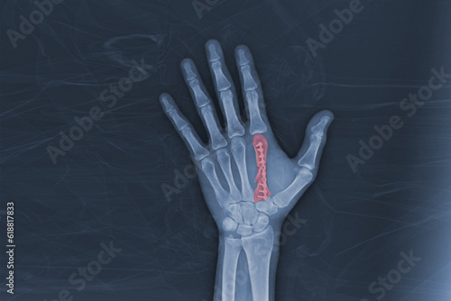 X-ray showing plate fixation for 2th Metacarpal fracture.Medical image concept.