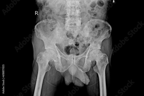 The radiography show metastasis cancer to pelvis and femur bone Medical healthcare concept. photo