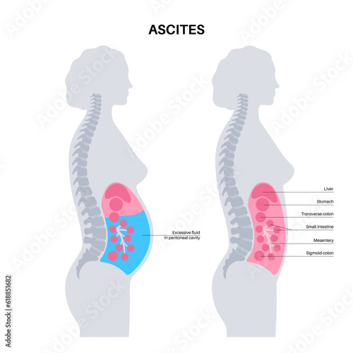 Ascites disease poster