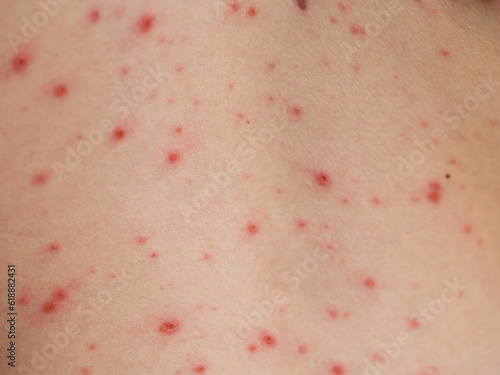 Obraz na plátně Close-up shot of a child body suffers from chickenpox (varicella)