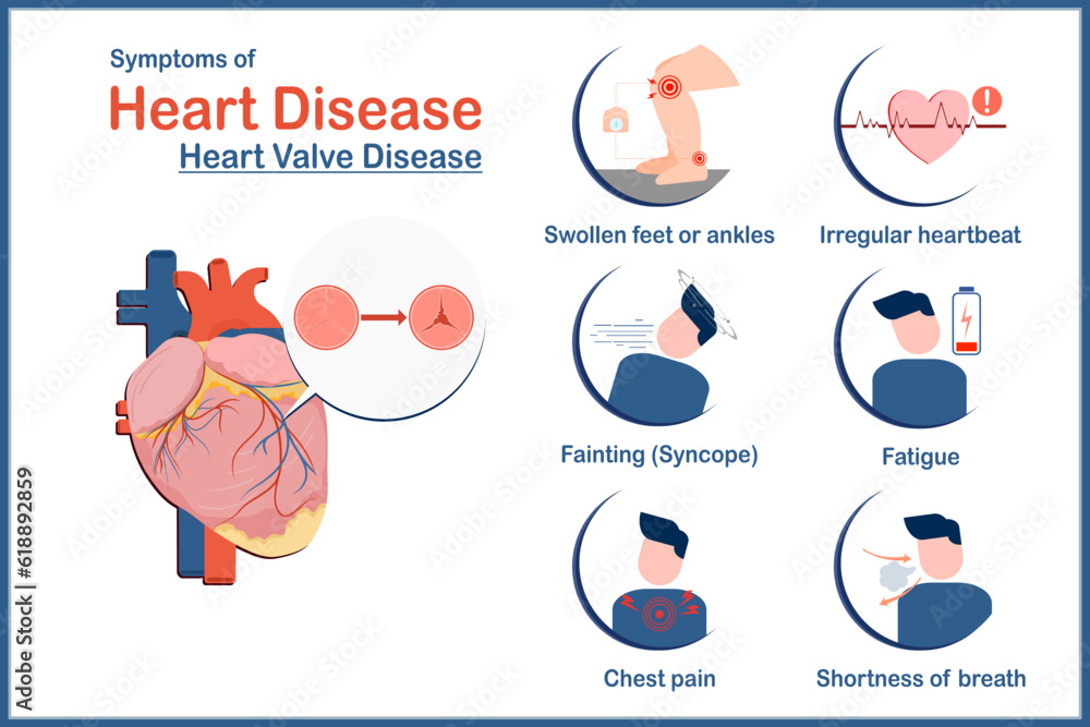 Medical illustration vector concept,symptoms of heart disease caused by heart valve disease.swollen feet or ankles,irregular heartbeat,fatigue,Shortness of breath,fainting or syncope flat style.