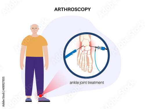 Ankle arthroscopy poster
