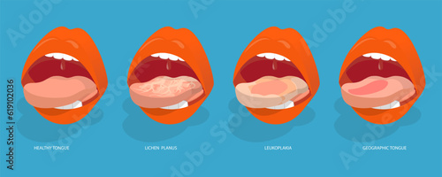 3D Isometric Flat Vector Conceptual Illustration of Sore Or White Tongue, Definition of the Disease by Tongue