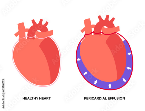 Pericardial effusion heart