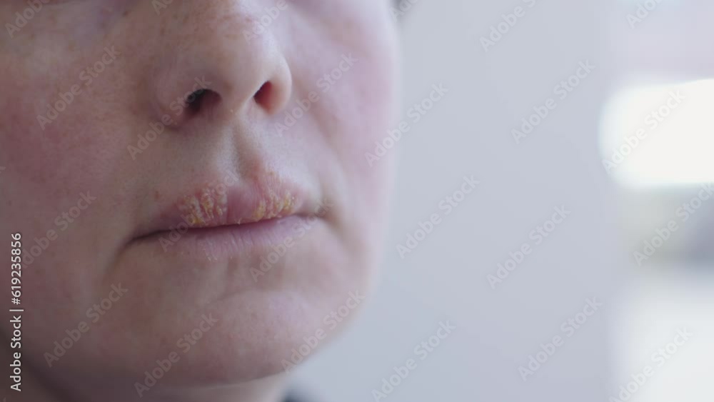 closeup herpes on female lips. unrecognizable woman suffering big