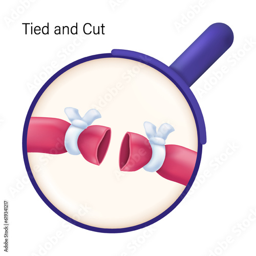 Tied and cut method of female sterilization. Tubal ligation vector. The fallopian tubes are blocked.  