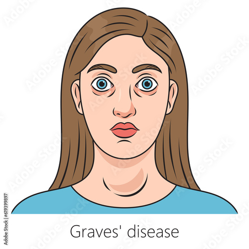 Woman with Graves' disease toxic diffuse goiter diagram schematic raster illustration. Medical science educational illustration