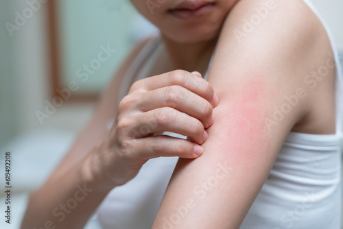 skin problem and beauty. Young woman scratch body has itchy skin from skin allergic, steroid allergy, sensitive skin, red from sunburn, chemical allergy, rash, insect bites, Seborrheic Dermatitis.