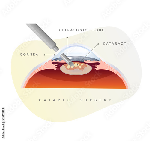 Human Eye - Cataract Procedure - Illustration