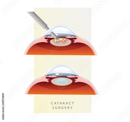 Human Eye - Cataract Procedure - Illustration