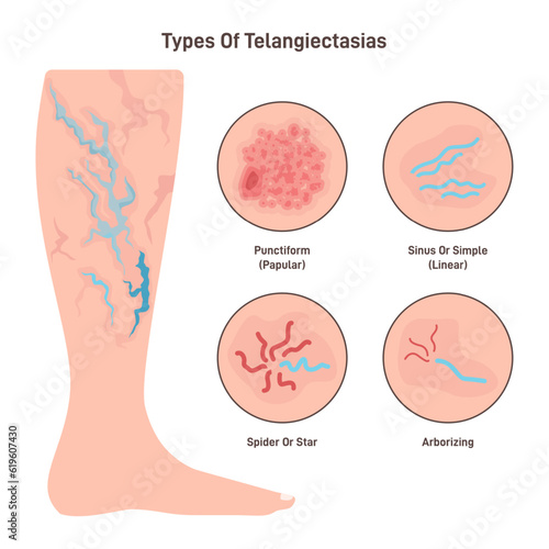 Telangiectasia types set. Varicose veins pattern, dilated blood vessels photo