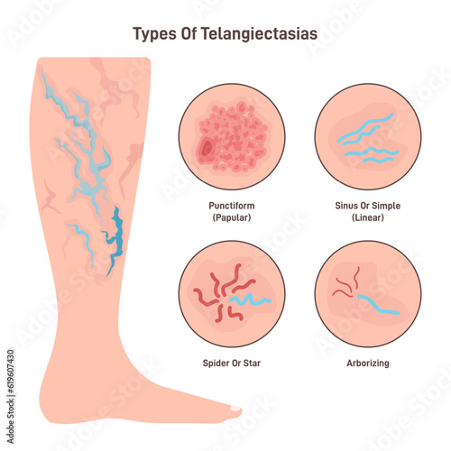 Telangiectasia types set. Varicose veins pattern, dilated blood vessels