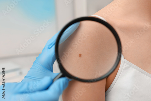 Dermatologist examining patient's birthmark with magnifying glass indoors, closeup