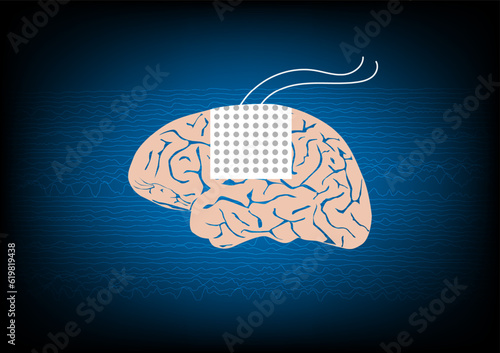 Illustration of subdural electrode over brain surface for EEG or brain waves monitoring in epilepsy surgery.