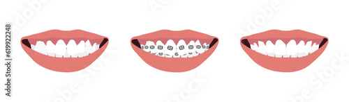 Vector illustration of the stages of orthodontic treatment braces on teeth . Teeth before and after braces on . Background in flat style