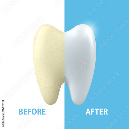 Vector Banner with 3d Realistic Tooth Closeup. Cleaning Concept - Before and After Hygienic Teeth Cleaning. Dentistry Design. Medical, Toothpaste Advertisement. Healthy Oral Hygiene, Teeth Whitening