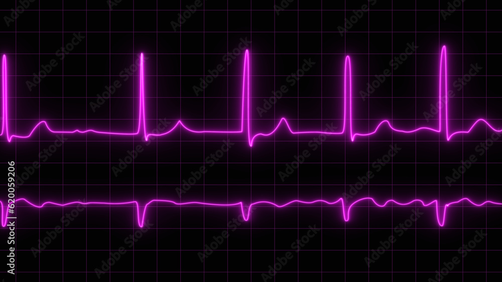 ECG or EKG pulse heartbeat purple line symbol on black background. fibrillation. ECG with brief paroxysms of supraventricular extrasystole and neon atrial fibrillation. ECG or EKG pulse heartbeat purple line symbol on black background. fibrillation. ECG with brief paroxysms of supraventricular extrasystole and neon atrial fibrillation.