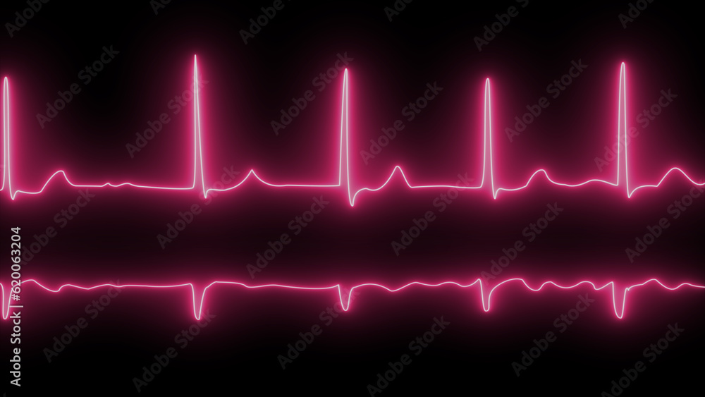 ECG or EKG pulse heartbeat purple line symbol on black background. fibrillation. ECG with brief paroxysms of supraventricular extrasystole and neon atrial fibrillation.