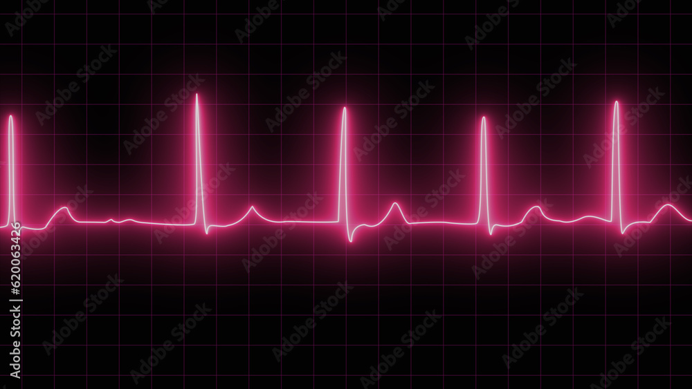 Close up of a medical monitor with purple lines of ECG showing atrial fibrillation. neon Close up of electrocardiogram chart background