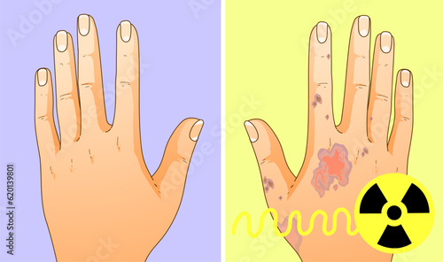 Effects of radiation on human health. Skin lesion. Healthcare illustration, medical illustration. Vector illustration. 