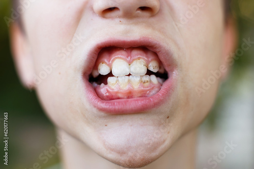 open mouth of a child boy with plaque or calculus on the teeth close. oral hygiene concept