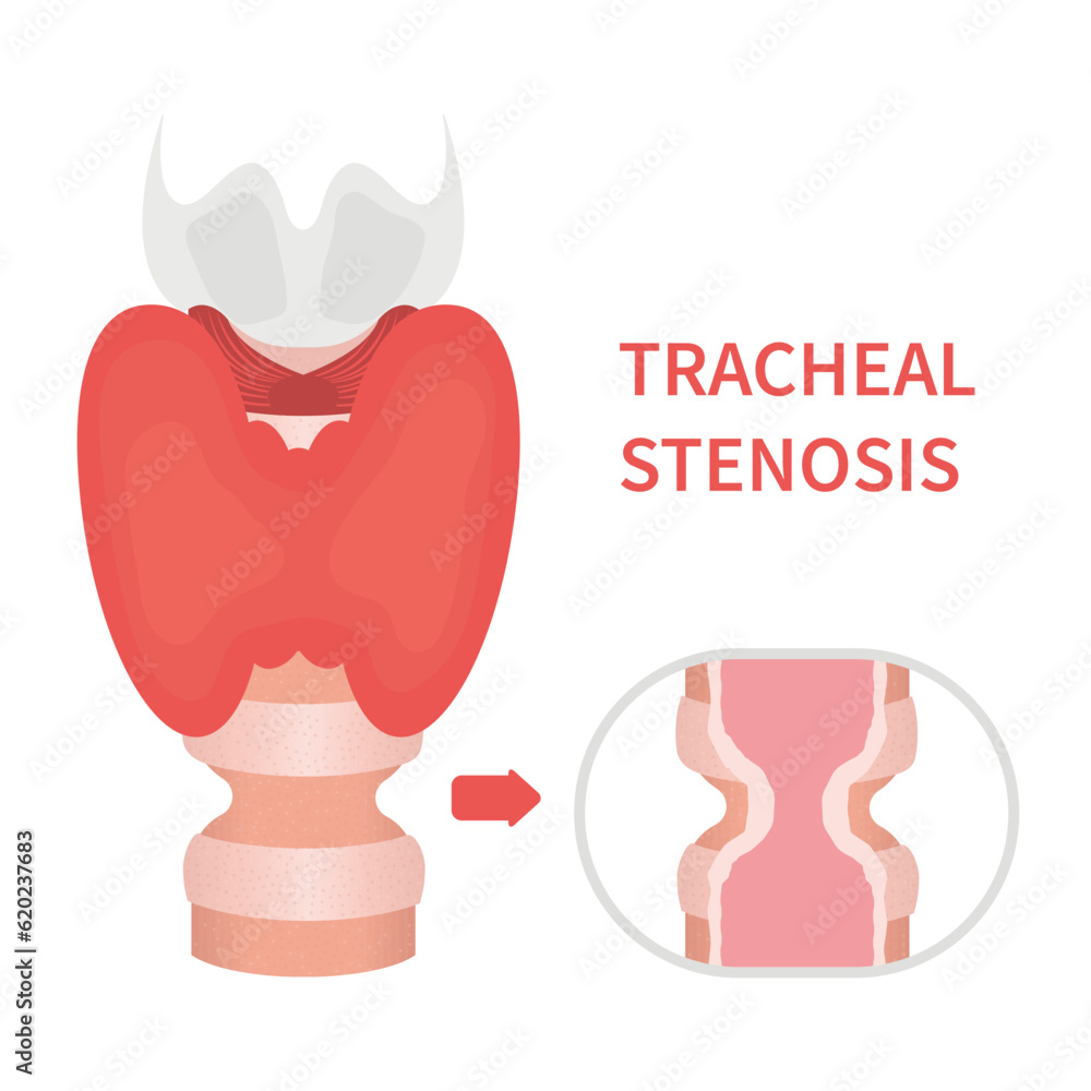 Tracheal stenosis awareness illustration. Trachea narrowing symbol. Difficulty breathing, hoarseness and voice change symptoms. Healthcare concept. Isolated flat vector illustration. Tracheal stenosis awareness illustration. Trachea narrowing symbol. Difficulty breathing, hoarseness and voice change symptoms. Healthcare concept. Isolated flat vector illustration.