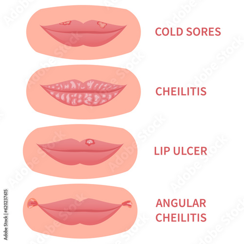 Mouth disease medical set. Cold sores and angular cheilitis with cracked corners. Lips ulcer inflamation with cracking and peeling skin. Dermatitis outbreak. Medical concept. Vector illustration.