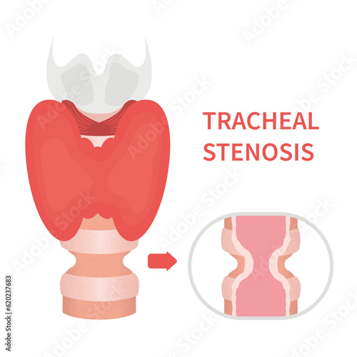 Tracheal stenosis awareness illustration. Trachea narrowing symbol. Difficulty breathing, hoarseness and voice change symptoms. Healthcare concept. Isolated flat vector illustration.