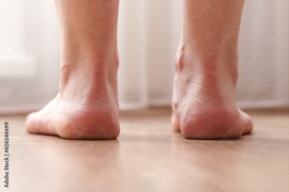 Dry skin on the heel cracks. Treatment concept with moisturizing creams