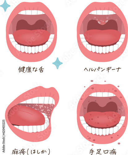 tongue,koplik spots,measles,hand-foot-and-mouth disease,illustration, photo