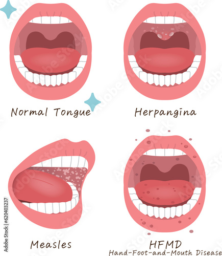 舌のトラブル・疾患のイラスト・麻疹・ヘルパンギーナ・手足口病