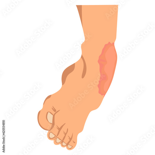 sprain