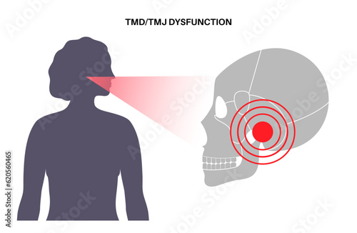 TMD TMJ disorder