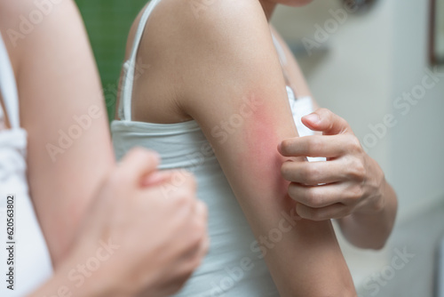 skin problem and beauty. Young woman scratch body has itchy skin from skin allergic, steroid allergy, sensitive skin, red from sunburn, chemical allergy, rash, insect bites, Seborrheic Dermatitis... photo