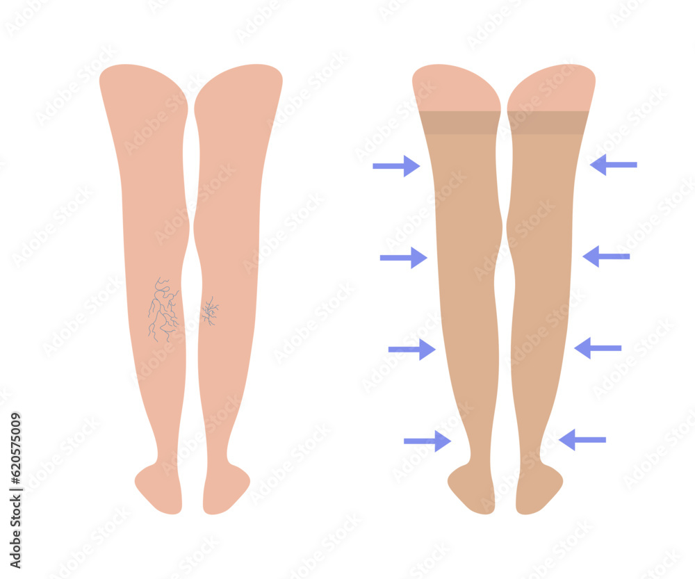 Varicose veins. Women's compression stockings. Female legs behind with
