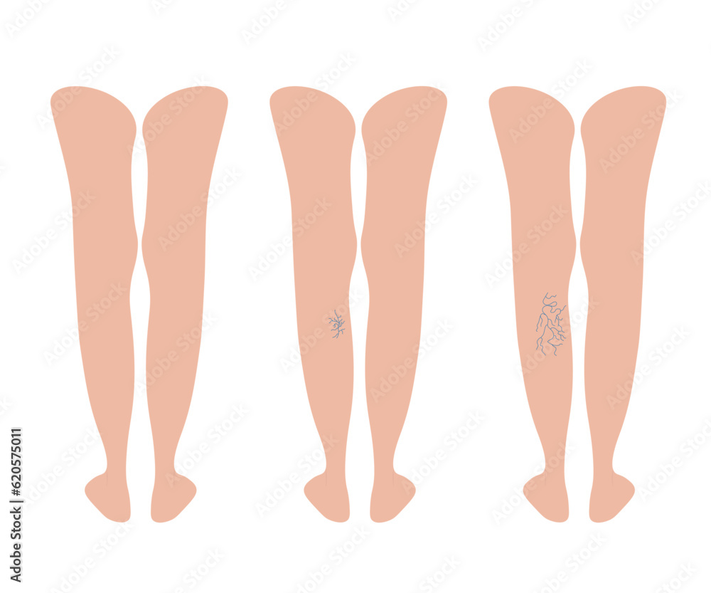 Varicoses. Different stages of varicose veins. Female legs behind