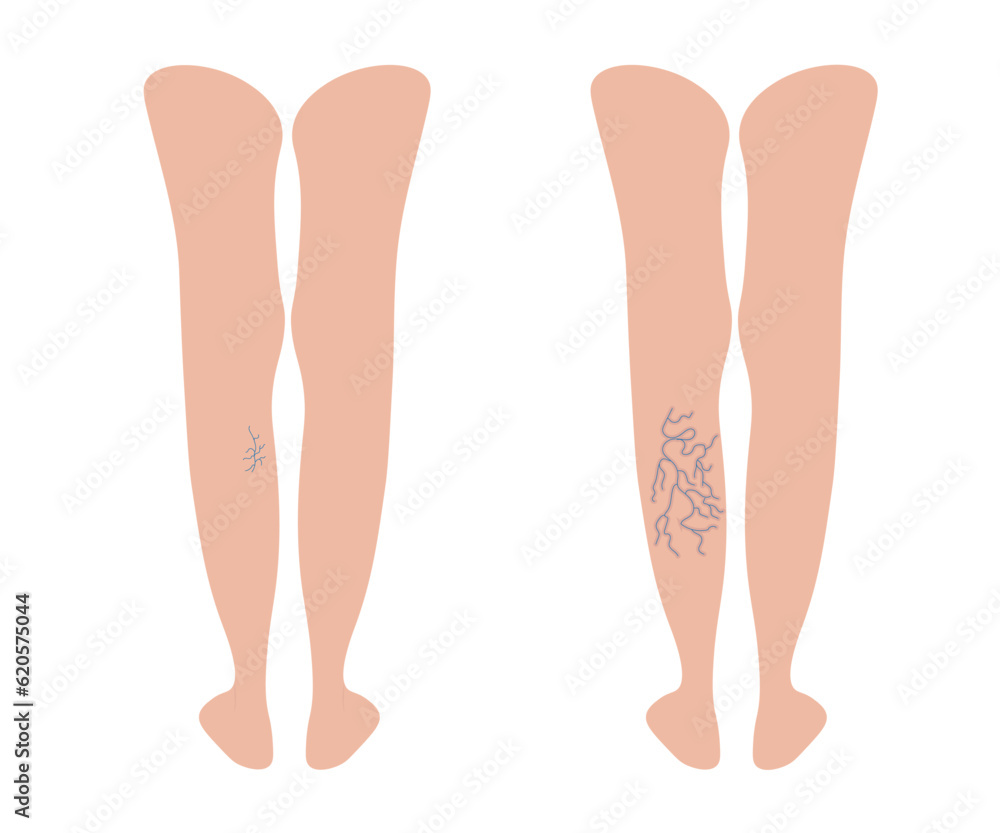 Varicoses. Different stages of varicose veins. Female legs behind