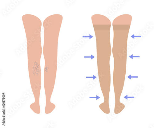 Varicose veins. Women's compression stockings. Female legs behind with Varicoses. Medical underwear for feet. Blood pressure, pain and swelling. Specialized hosiery for diseases. Vector illustration.
