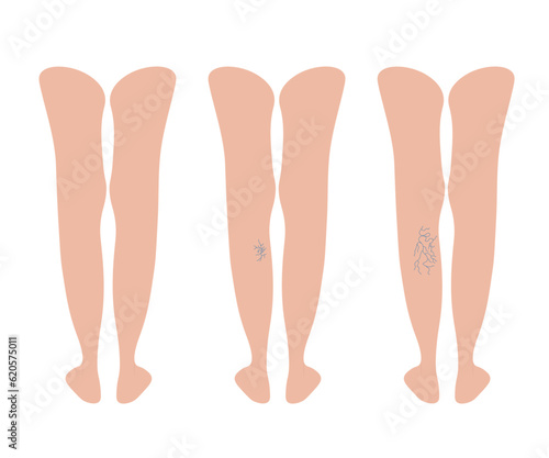 Varicoses. Different stages of varicose veins. Female legs behind. Blood pressure, pain and swelling. Disease of weak veins and valves. Vector illustration for medicine isolated on white background.