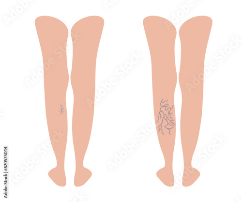 Varicoses. Different stages of varicose veins. Female legs behind. Blood pressure, pain and swelling. Disease of weak veins and valves. Vector illustration for medicine isolated on white background.
