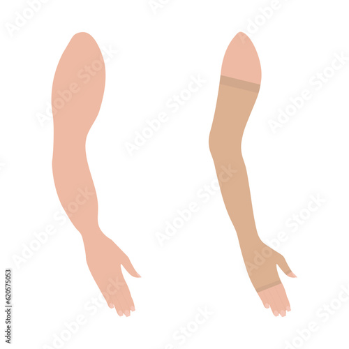 Lymphedema. Female arm in Compression Sleeve with finger. Woman's hand. Swelling, Edema, Post Surgery. Support. Medical underwear. Specialized hosiery for diseases. Vector illustration.