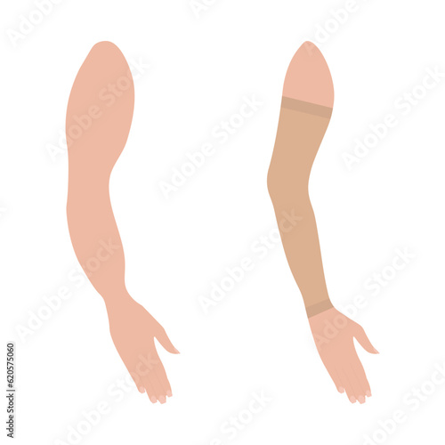 Lymphedema. Female arm in Compression Sleeve. Woman's hand. Swelling, Edema, Post Surgery. Support. Medical underwear. Specialized hosiery for diseases. Vector illustration.