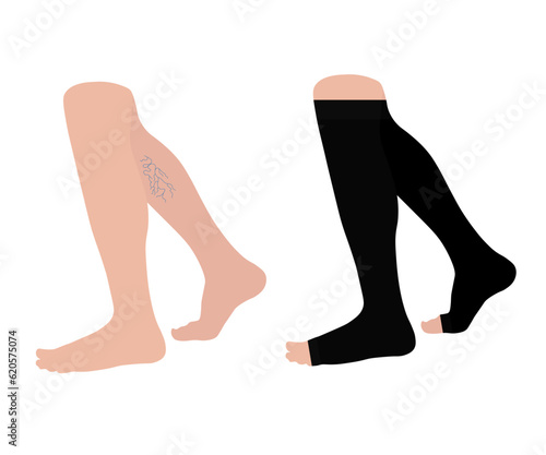 Male legs with varicose veins. Blood pressure, pain and swelling. Men's Knee-high compression stockings open toe. Long socks. Medical underwear. Specialized hosiery for diseases. Vector illustration.