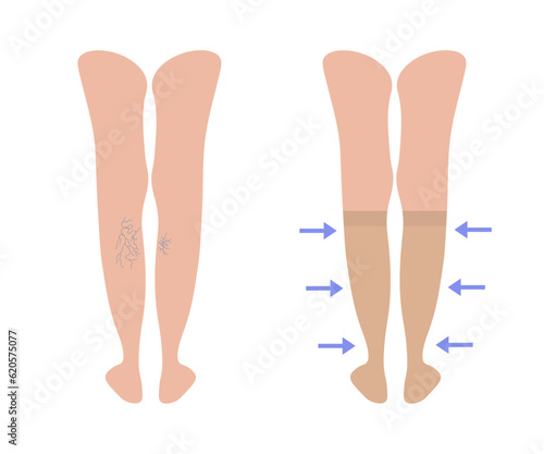 Varicose veins. Women's Knee-high short compression stockings. Female legs behind with Varicoses. Medical underwear for feet. Blood pressure. Specialized hosiery for diseases. Vector illustration.