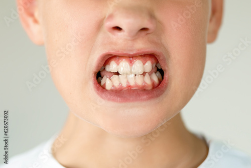 An open mouth revealing a child's crooked teeth. Dental Medicine and Health